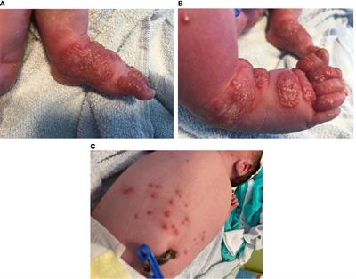 Case Report: Symptomatic Chronic Granulomatous Disease in the Newborn